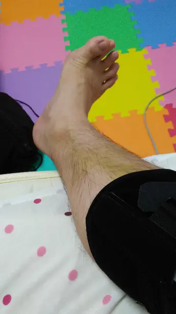 [実体験]前十字靭帯再建手術を受けて復帰するまで③[自宅安静～抜糸～松葉づえ卒業まで]